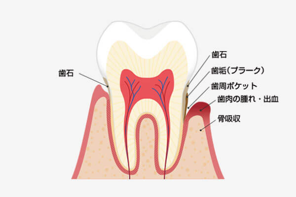 歯周病とは 日進市 歯科 歯医者 の荒川歯科